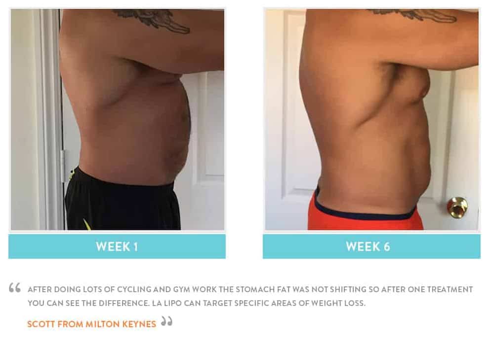 Before & After Stomach Fat Walsall