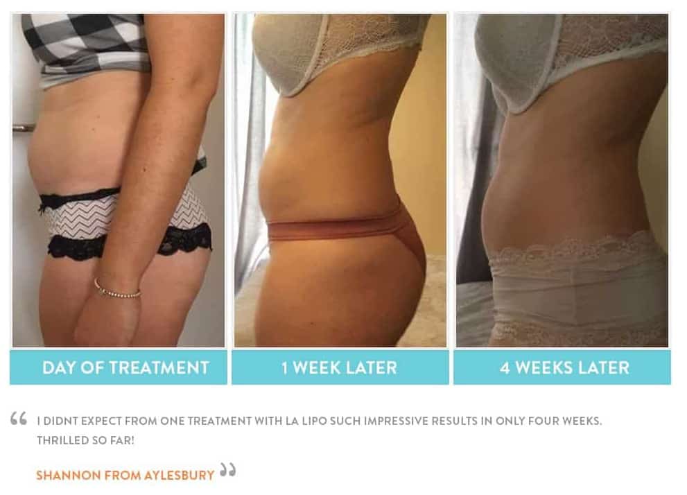 before, Cryolipolysis Walsall