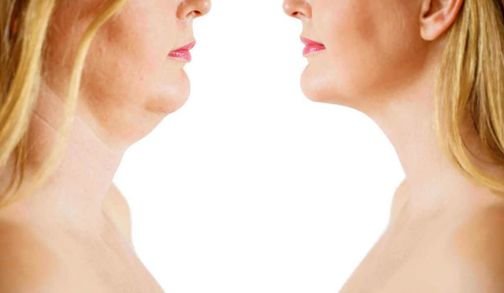 Double Chin treatment Walsall before and after results