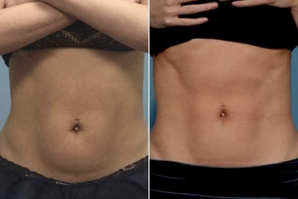 body sculpting FAQs Walsall