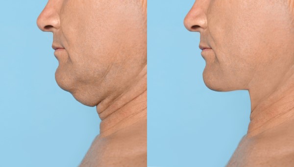 Which Non-Surgical Treatments Work Best for Jowls and Loose Skin Walsall?