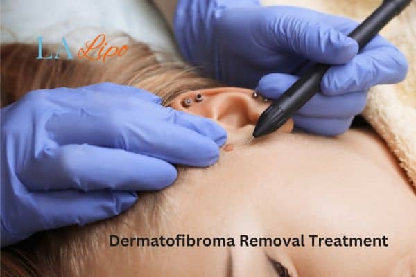 Dermatofibroma Removal Treatment Walsall