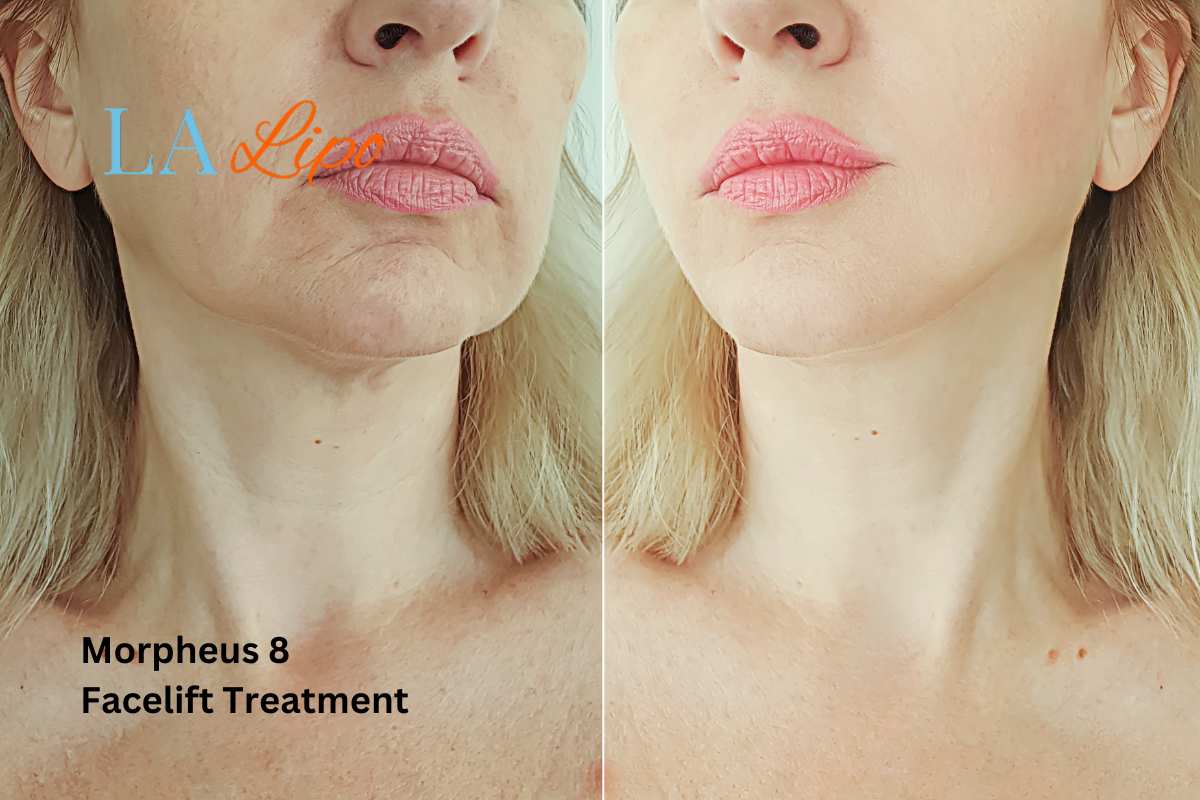 Turn back time with Morpheus8 Treatment Walsall