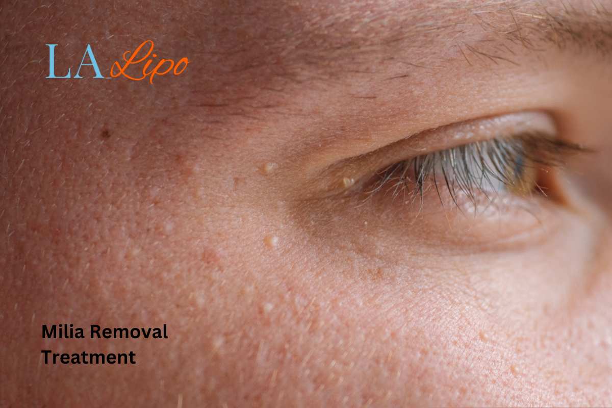 Cryopen Milia Removal: Is It the Easiest and Safest Option Walsall?