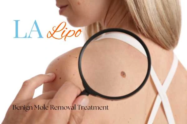 Why getting moles removed Walsall can boost your confidence!