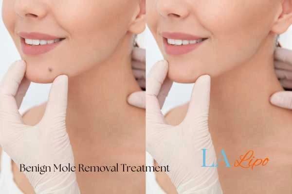 woman's before and after mole removal Walsall results