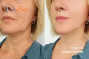 hi-fu for wrinkles Walsall before and after results
