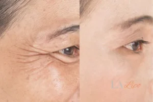 Before and after results of woman - HI-fu wrinkles reduction treatment Walsall