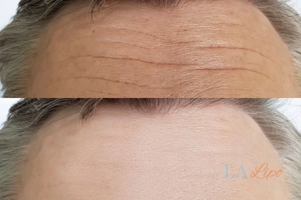 results of HIFU Walsall on mans forehead to help reduce lines and wrinkles