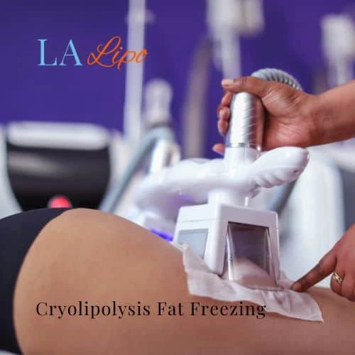 fat freezing - Cryolipolysis Walsall