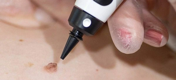skin tag removal using cryopen Walsall