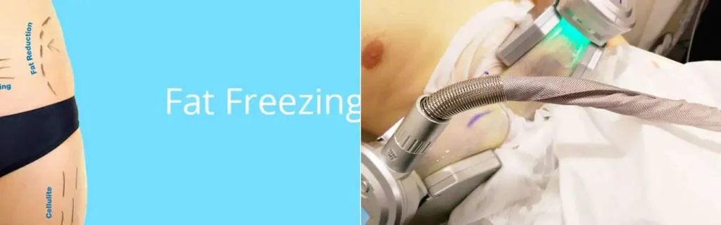 multi areas of a persons body having coolsculpting Walsall treatment