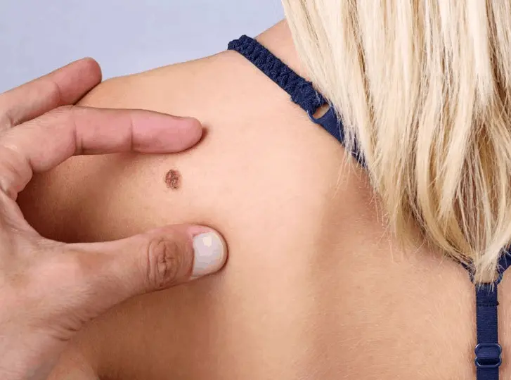 woman having mole removal Walsall consultation before treatment.