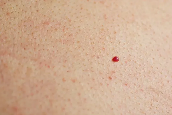 close up of a cherry angioma Walsall