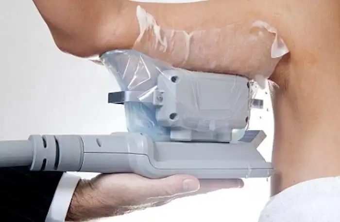 Picture of fat freezing Walsall on the upper arms.