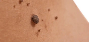 image of a skin tag Walsall