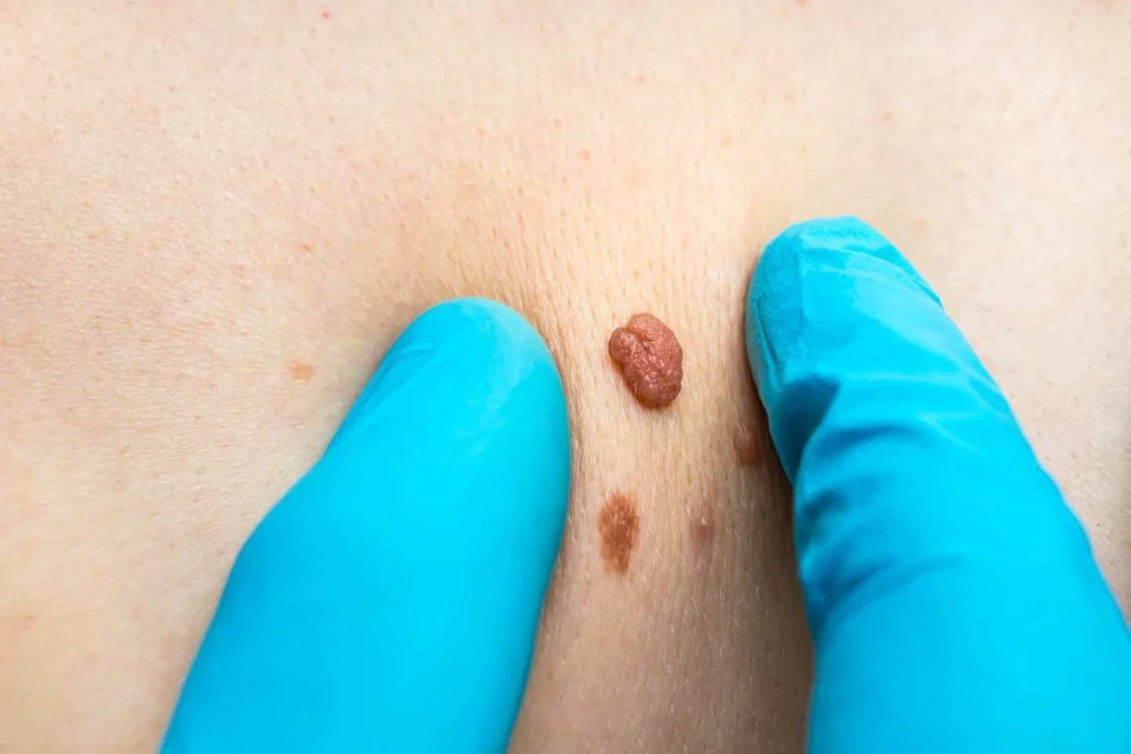 Consultant examining a skin tag Walsall