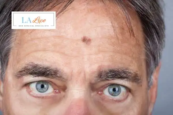 Solar Lentigo Removal Walsall image of man with mark on his forehead