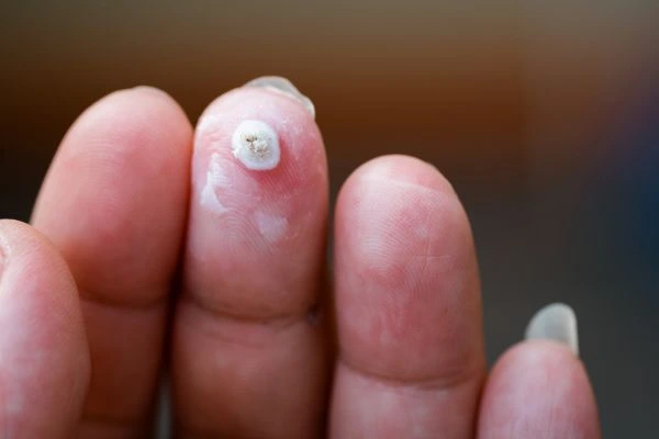 wart on person finger - cryotherapy to treat from LA LIPO Walsall