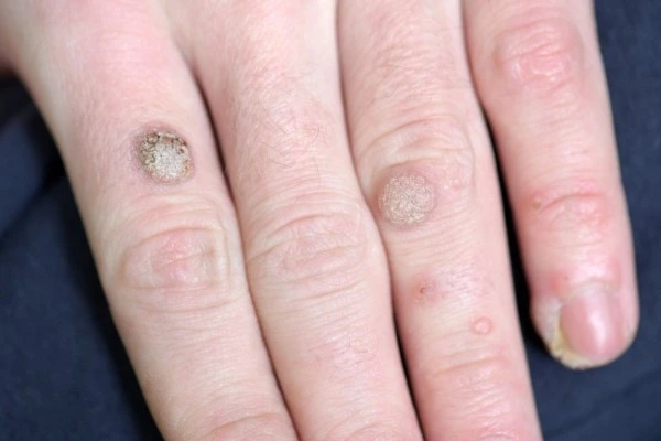 photo of warts on person hand - see wart removal Walsall from LA LIPO