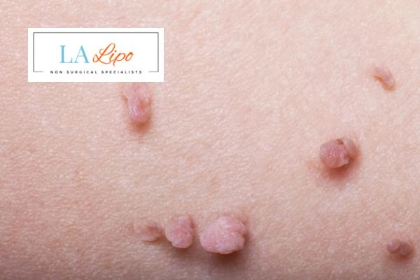 Does cryopen skin tag removal Walsall hurt? Find out now call our team today!