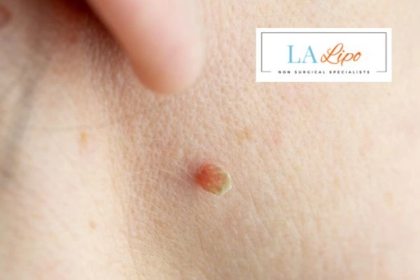 Book skin tag removal Walsall today speak to our team now!