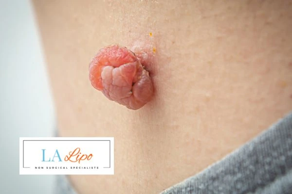 Interested in skin tag removal Walsall? Concerned about the pain? Find out more today!
