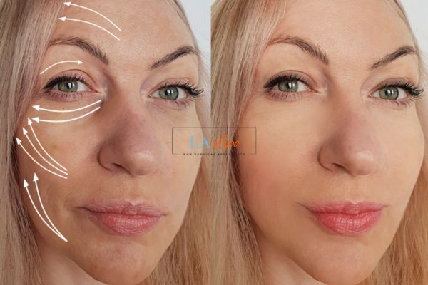 Morpheus 8 results Walsall face lift.