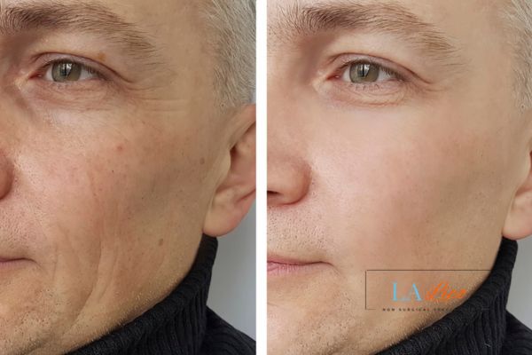 See the amazing results of Morpheus8 Treatment Walsall!