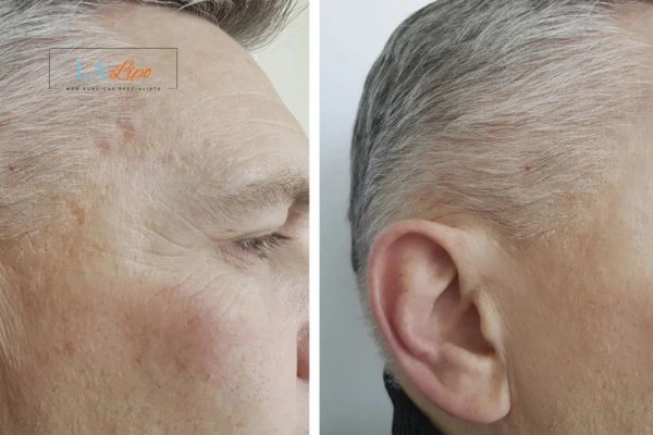 Mens Before & After Morpheus 8 Results Walsall