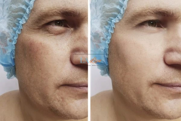 Before and after Morpheus 8 Results Walsall