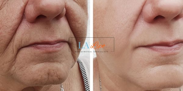 Older lady deeper wrinkle reduction - LA LIPO Morpheus 8 Results Walsall