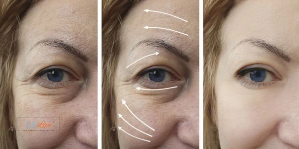 Amazing eye lift Morpheus 8 results Walsall