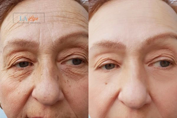 The powerful benefits of Morpheus8 Treatment Walsall - Call Our team today!