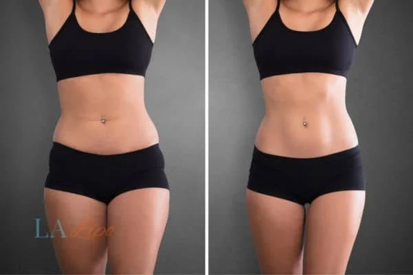 before and after results of non-surgical treatment to help a woman's body image and mental health Walsall