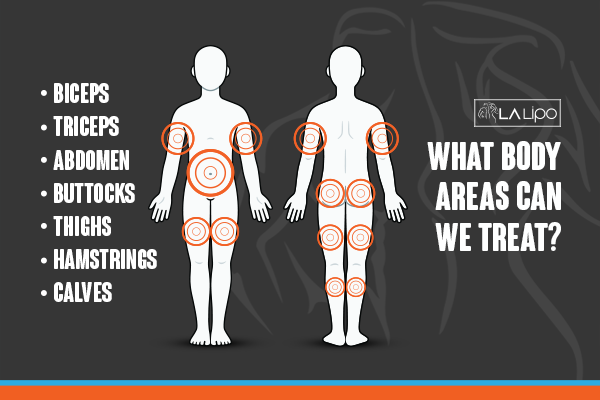 Diagram to show areas you can have LA-EMS Body Sculpting Treatment Walsall