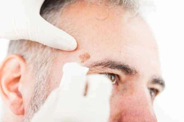 Age spots and elderly people Walsall what is the link?
