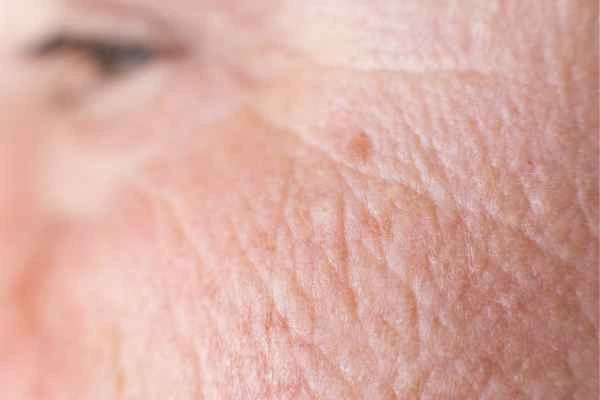 close up picture of a woman's face showing an age spot Walsall