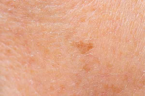 close up picture of age spots Walsall