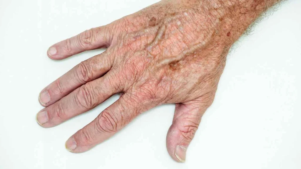 Male hand showing age spot Walsall