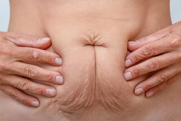 Image of a woman's stomach with loose skin - example of skin tightening Walsall options
