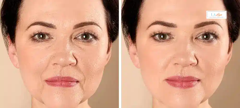 How Long Does It Take to See Results and How Long Do They Last Walsall?