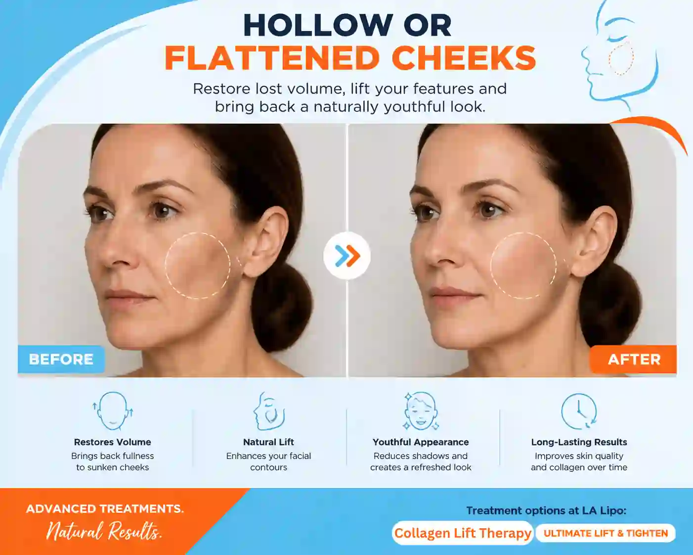 Sign #4: Hollow or Flattened Cheeks Walsall